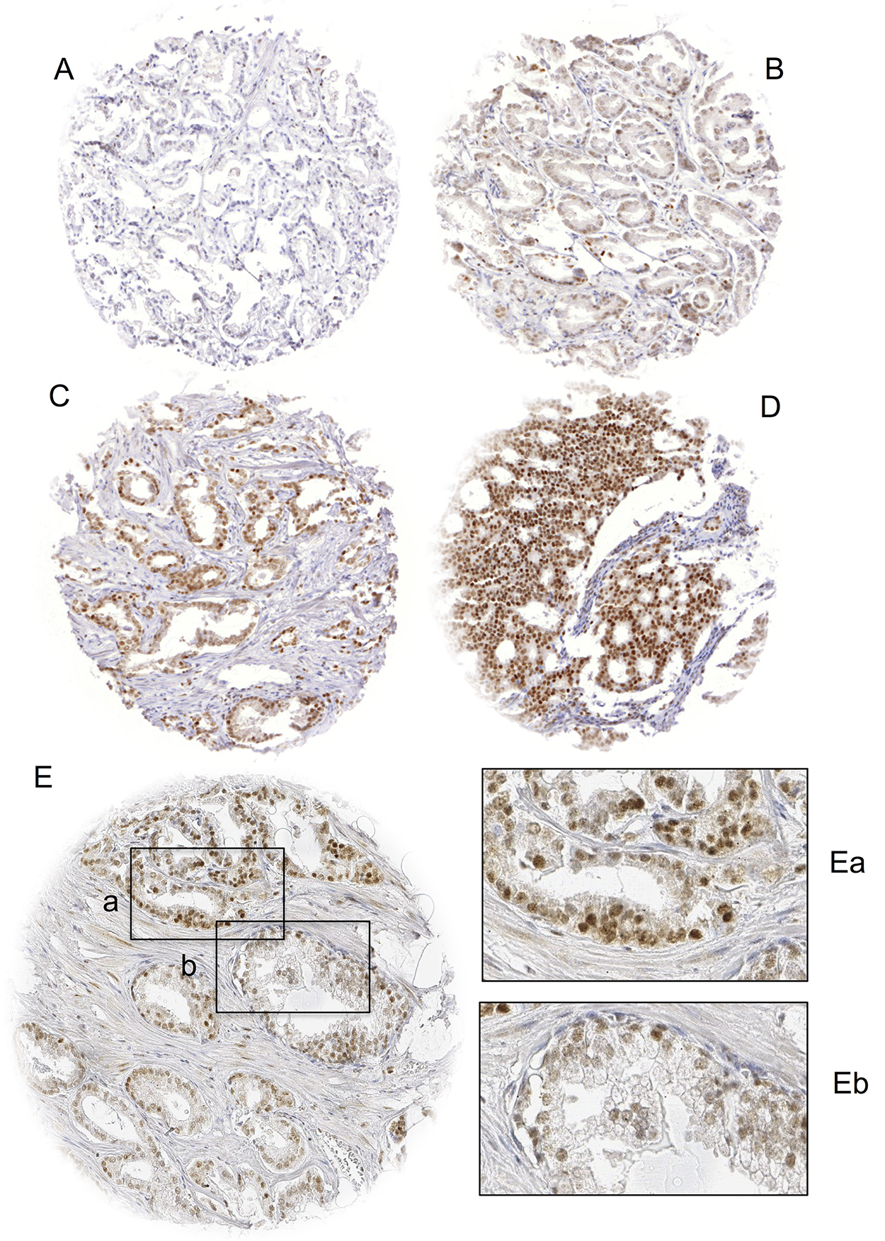Examples of (A) negative, (B) weak, (C) moderate and (D) strong BAP1 staining in prostate cancer and (E) BAP1 staining of cancerous (Ea) and normal (Eb) prostate glands in the same TMA spot. Spot size is 0.6 mm at 100x (inset 400x) magnification.