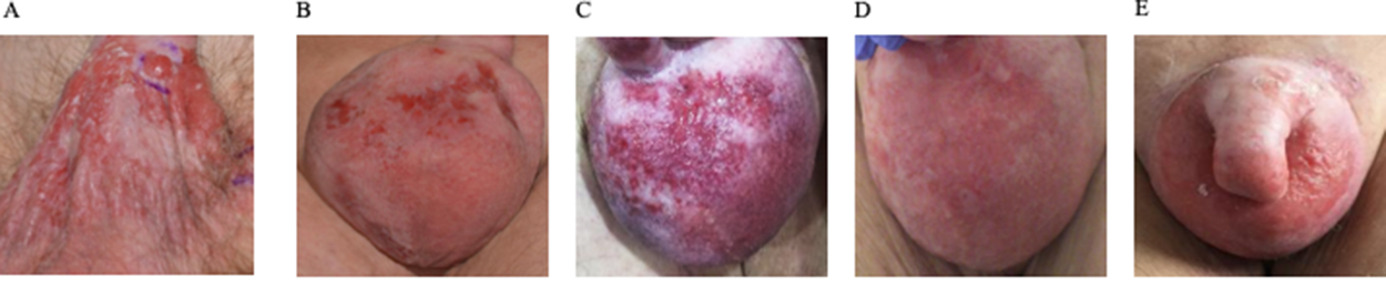 Therapeutic efficacy assessed by clinical penoscrotal examination