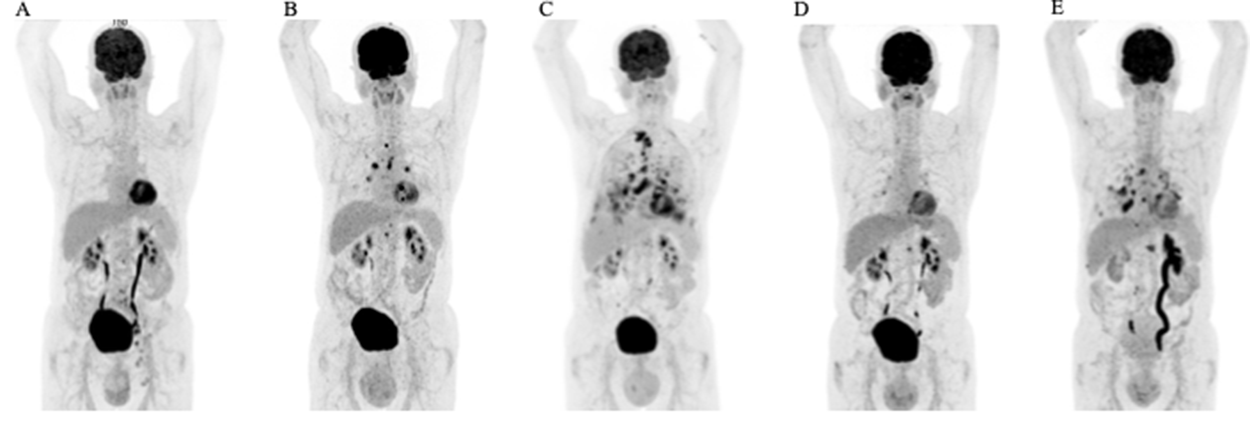 Therapeutic efficacy assessed by FDG-PET/CT scans