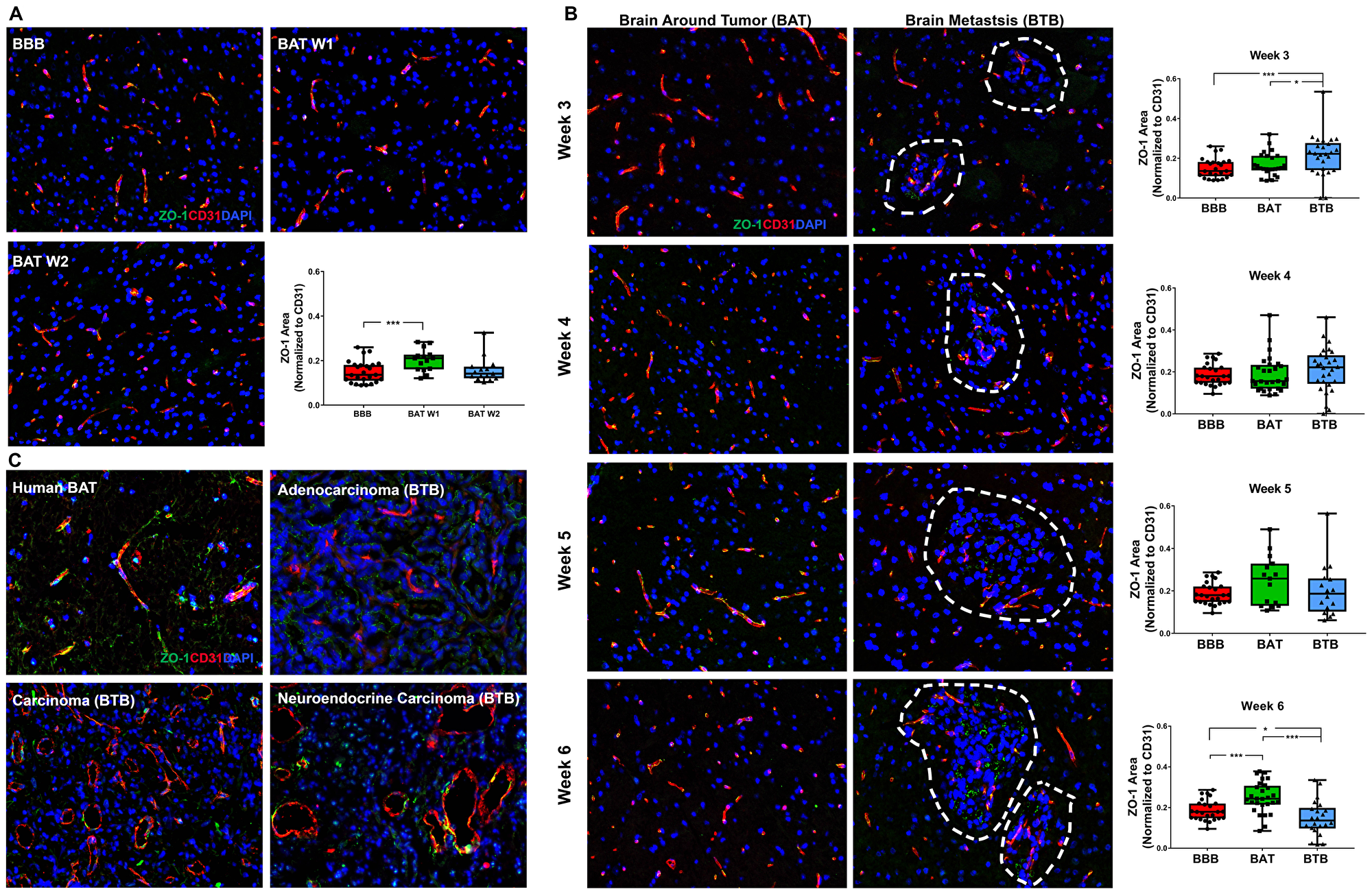 Altered ZO-1 expression in NSCLC brain metastases
