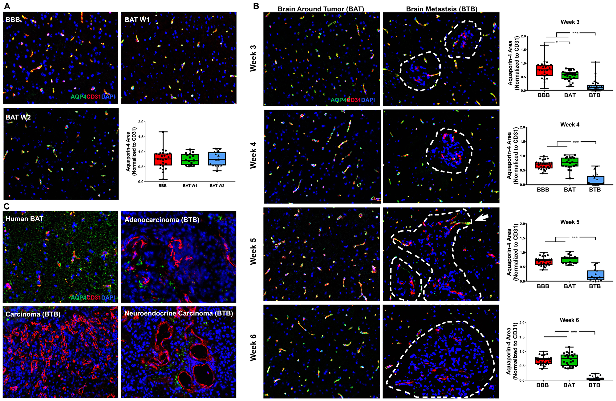 Catastrophic loss of the astrocytic endfeet water channel protein aquaporin-4 in NSCLC brain metastases