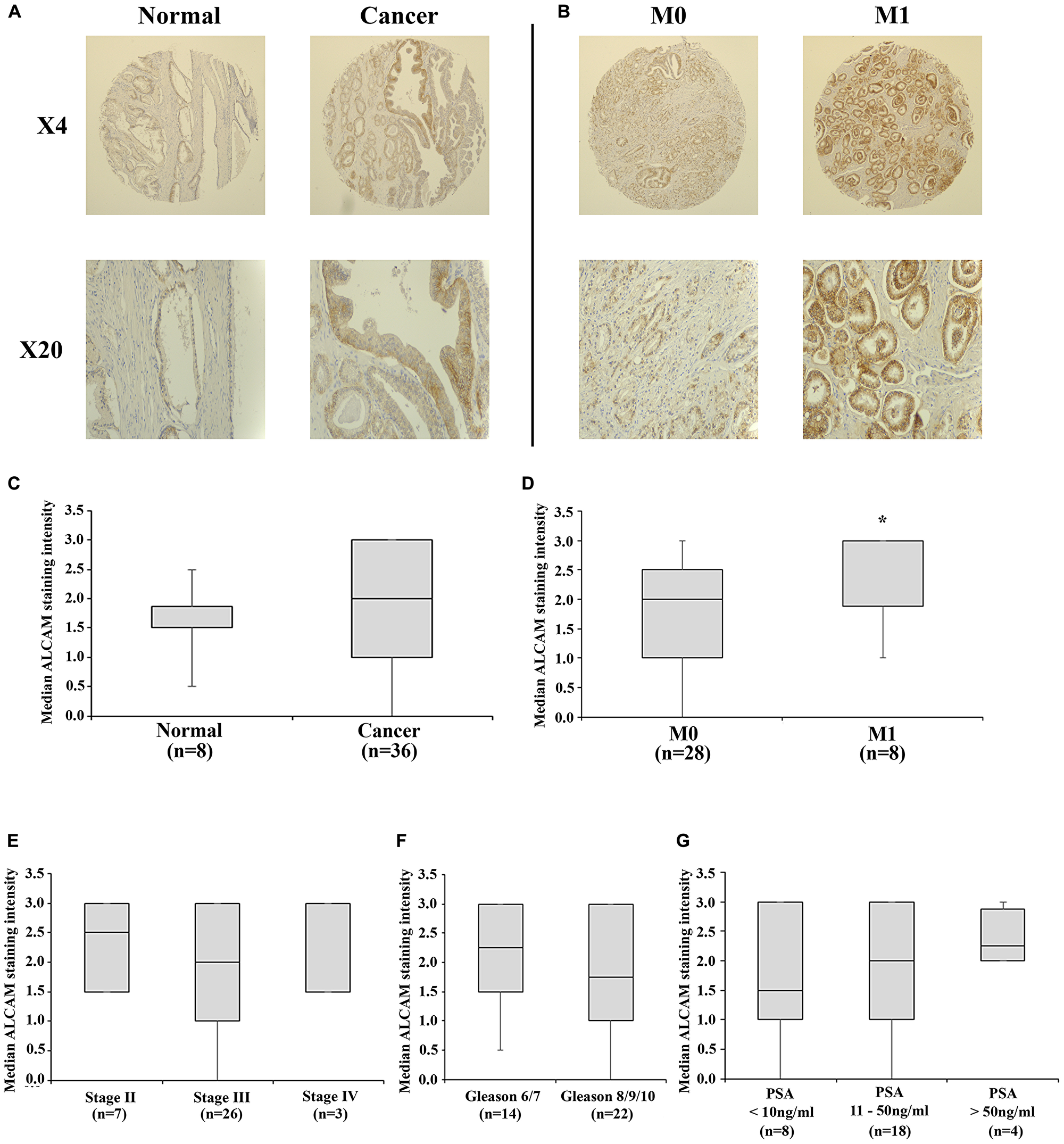 ALCAM tissue expression in a tissue microarray of prostate and prostate cancer tissues