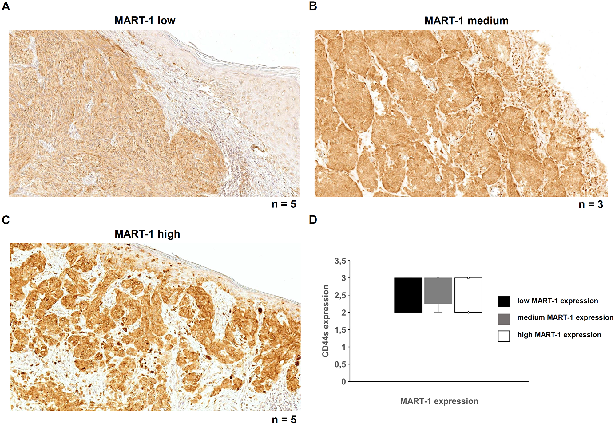 MART-1 expression and its correlation with CD44s expression in malignant melanoma