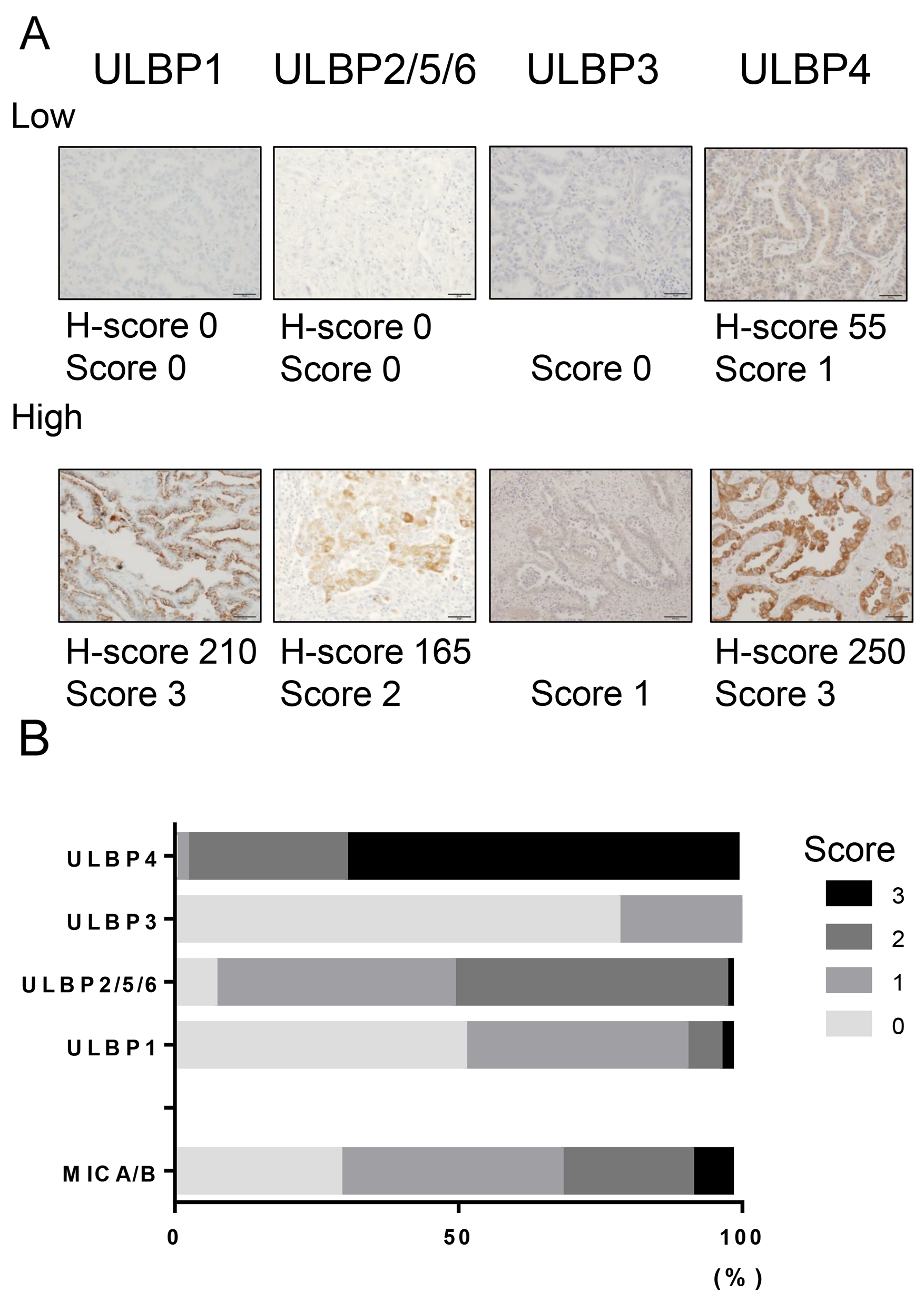 NKG2D ligand expression in NSCLC tissues