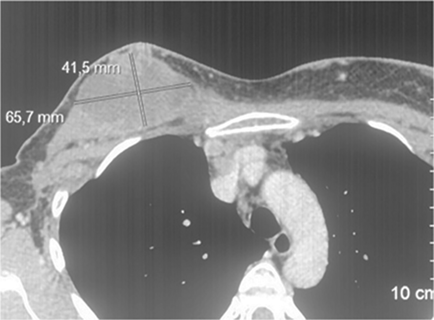 MSCT before the treatment with Elenagen and CMF chemotherapy (the lesion in chest soft tissue in upper left end is marked)