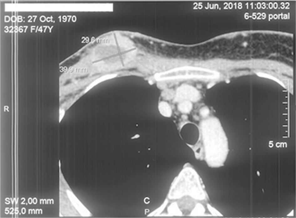 MSCT two months after Elenagen and CMF chemotherapy treatment