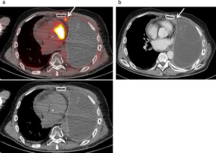 Local recurrence developed in a 67-year-old male following treatment for a malignant pleural mesothelioma, including neoadjuvant chemotherapy, left extrapleural pneumonectomy, radiotherapy, and chemotherapy