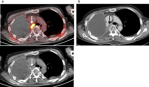 Lymph node recurrence developed in a 61-year-old male following treatment for a malignant pleural mesothelioma, including neoadjuvant chemotherapy, right extrapleural pneumonectomy, and radiotherapy