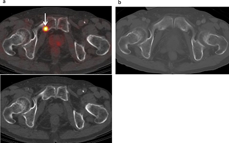 Bone metastasis developed in a 72-year-old male treated for malignant pleural mesothelioma, including pleurectomy and decortication procedures, and chemotherapy