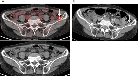 Muscle metastasis developed in a 73-year-old female following treatment for malignant pleural mesothelioma, including neoadjuvant chemotherapy, pleurectomy and decortication procedures, and chemotherapy