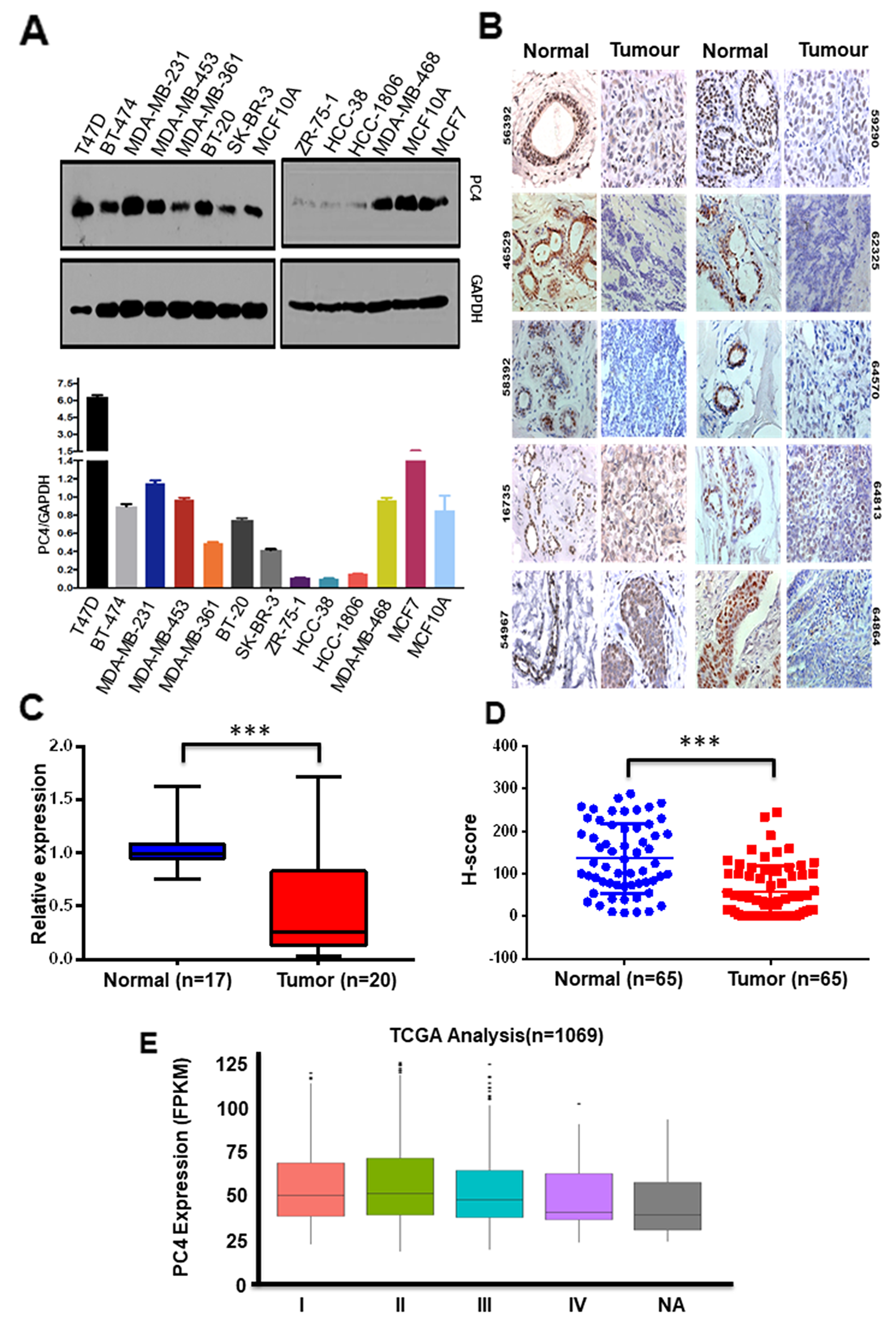 PC4 expression is predominantly downregulated in breast cancer patient samples