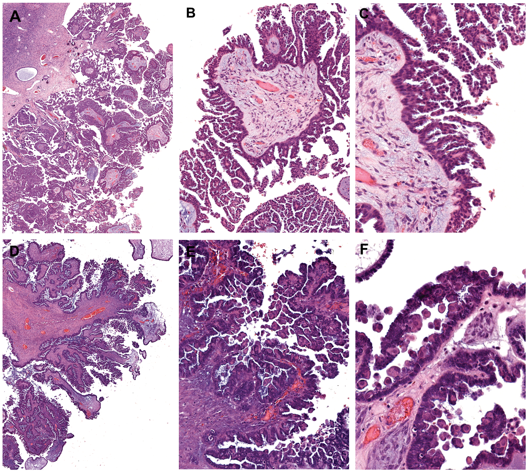 Histomorphologic features of micropapillary serous borderline tumor and BRAF-mutation-associated serous borderline tumor
