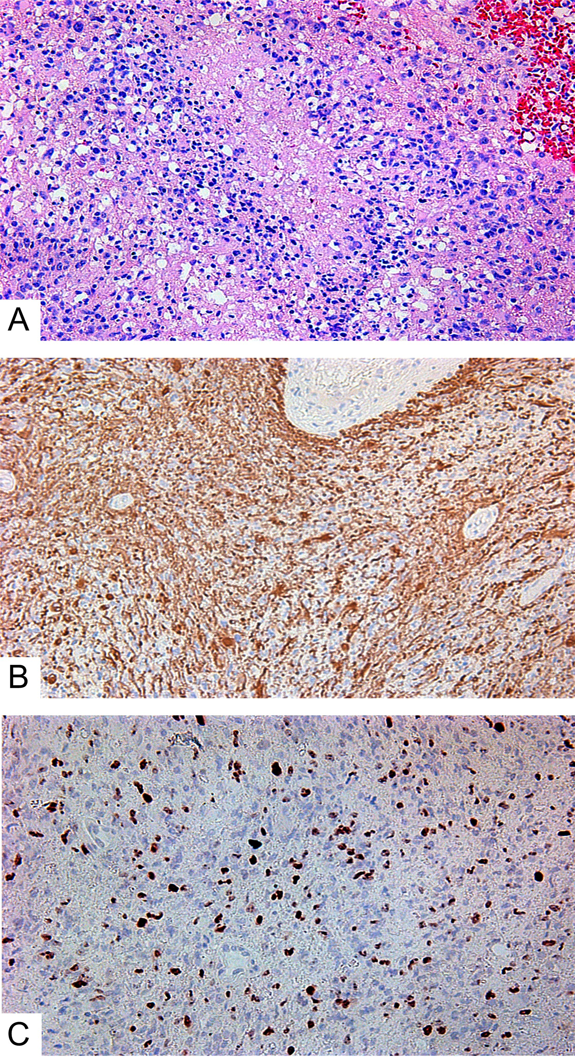 Small cell glioblastoma