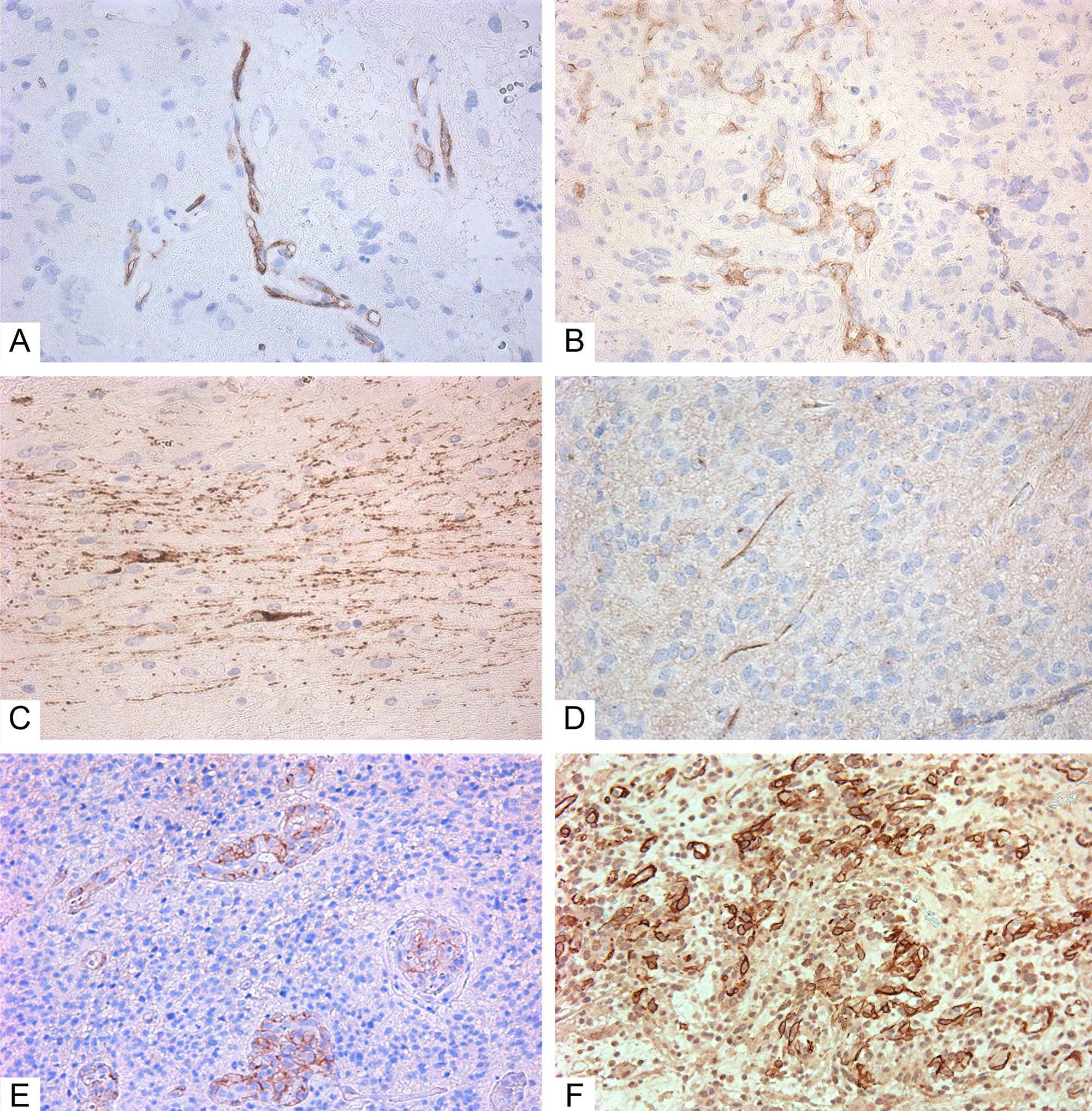 Immunohistochemistry of glioblastoma