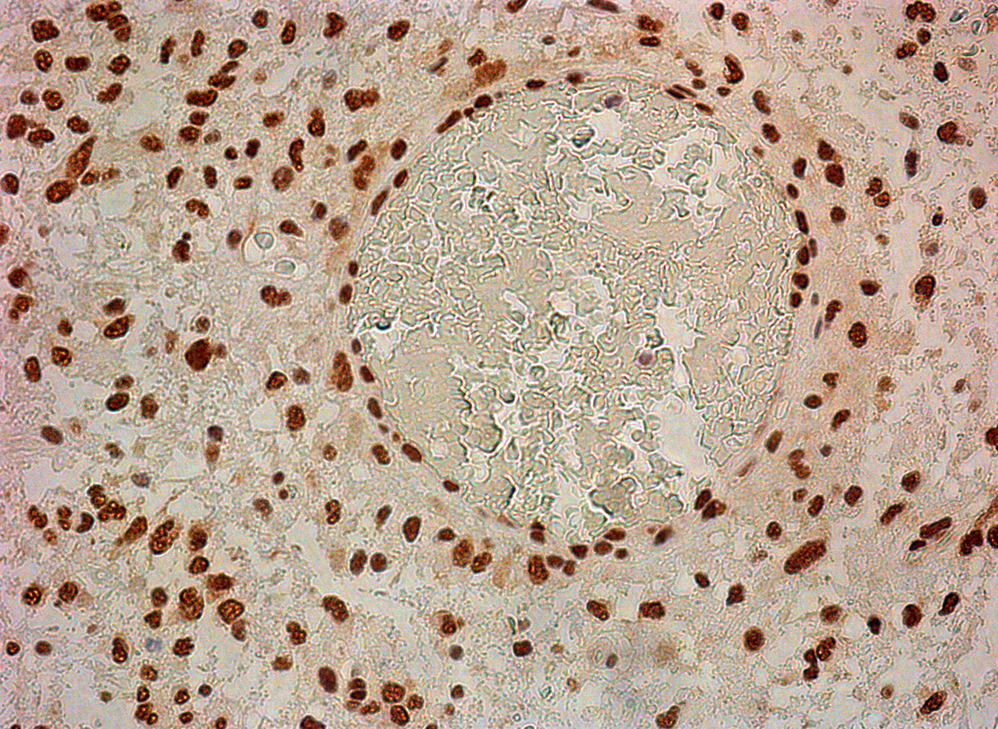 Neuro D1 in tumor cell nuclei and in vessel cells