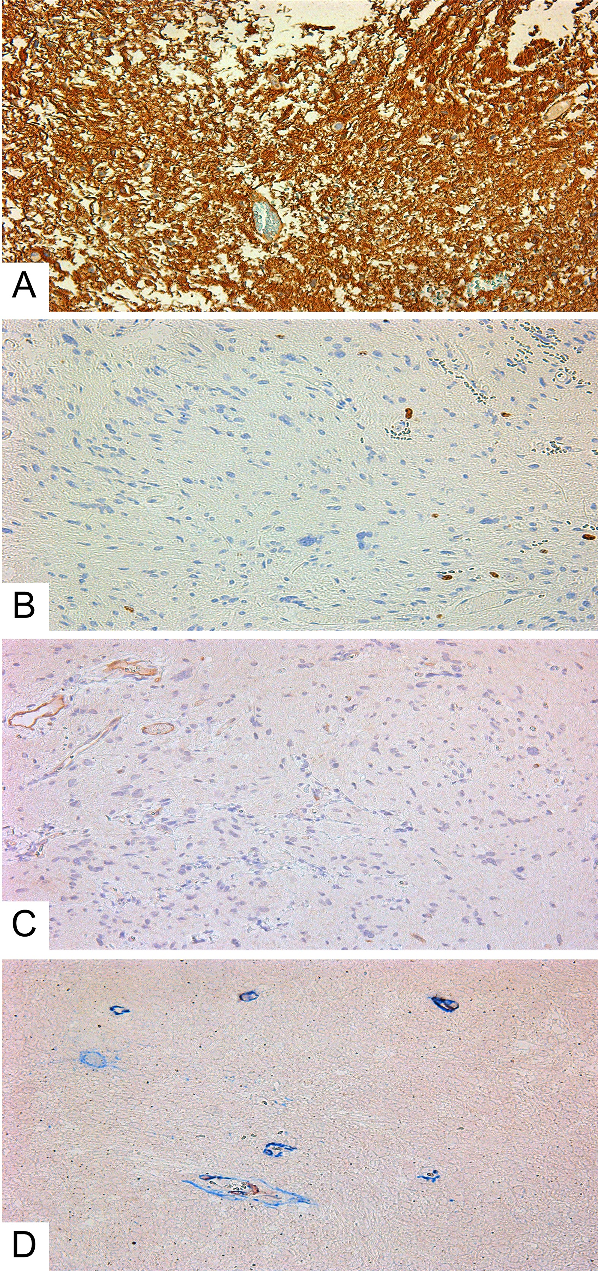 Diffuse astrocytoma