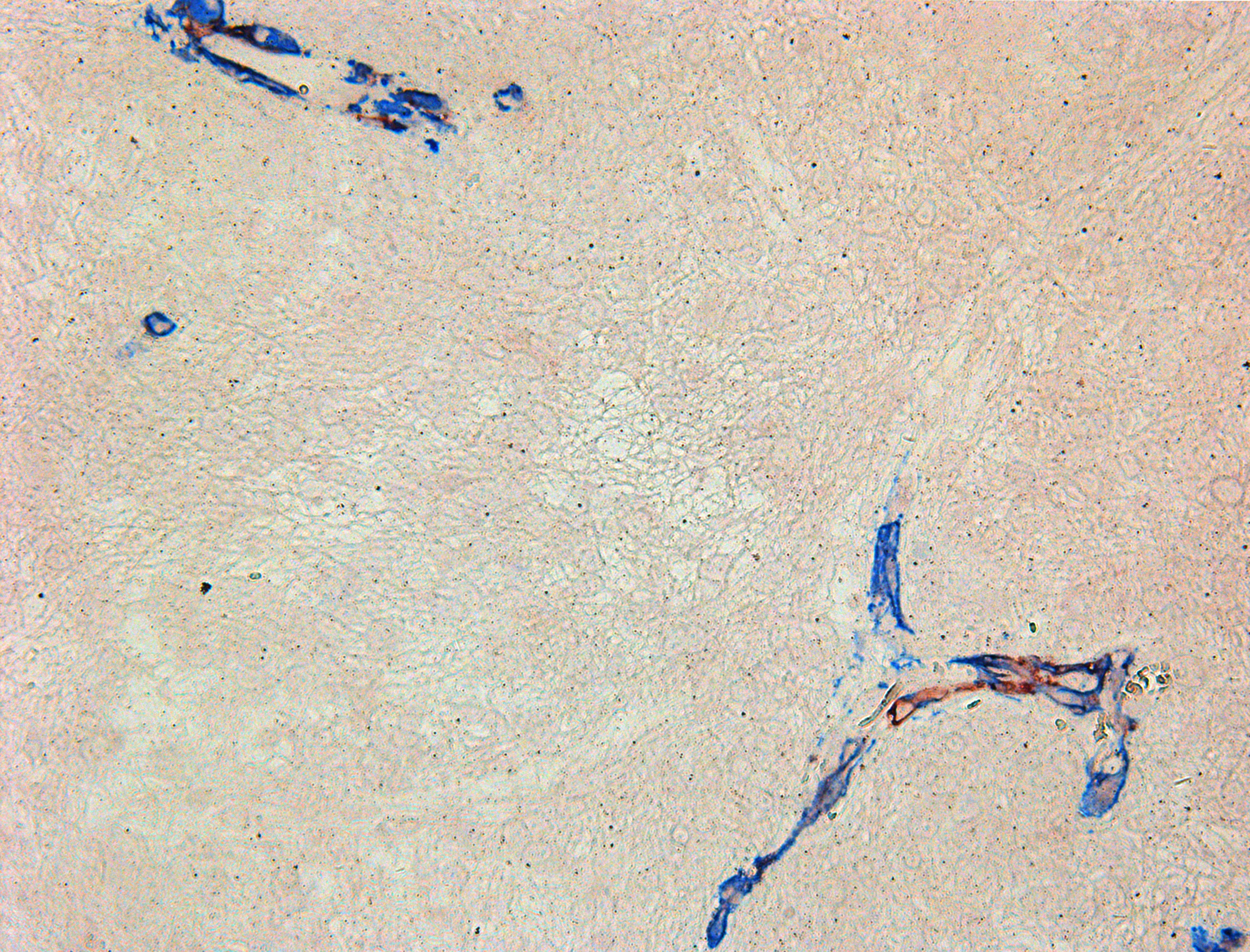Double-stain IHC of small cell glioblastoma with NG2/SMA antibodies