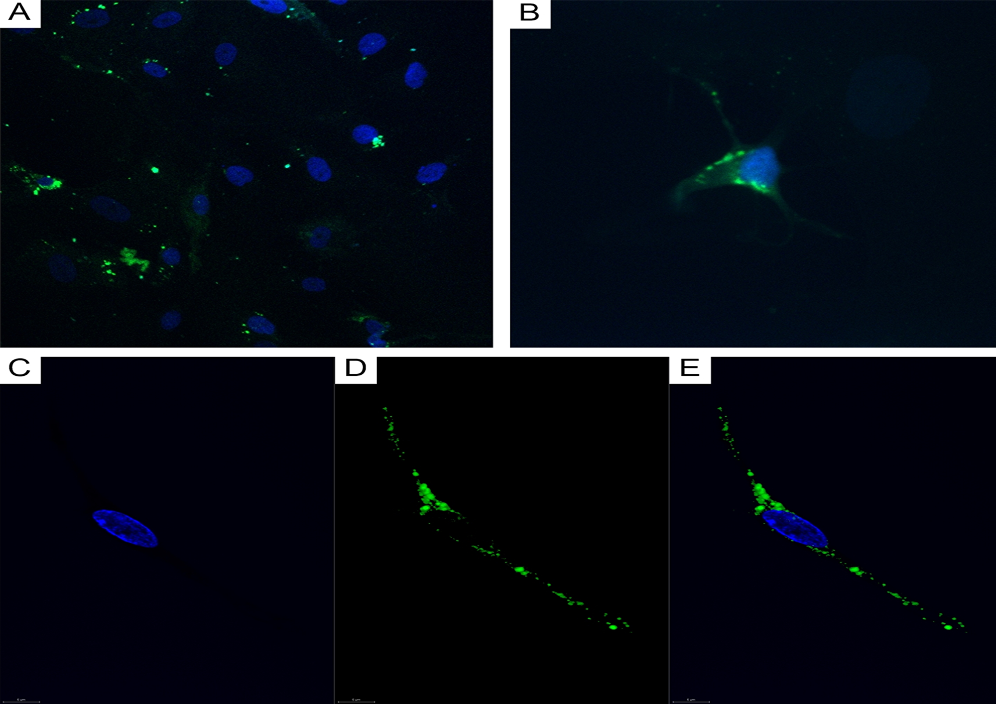 CLSM of glioblastoma and astrocytoma primary cultures