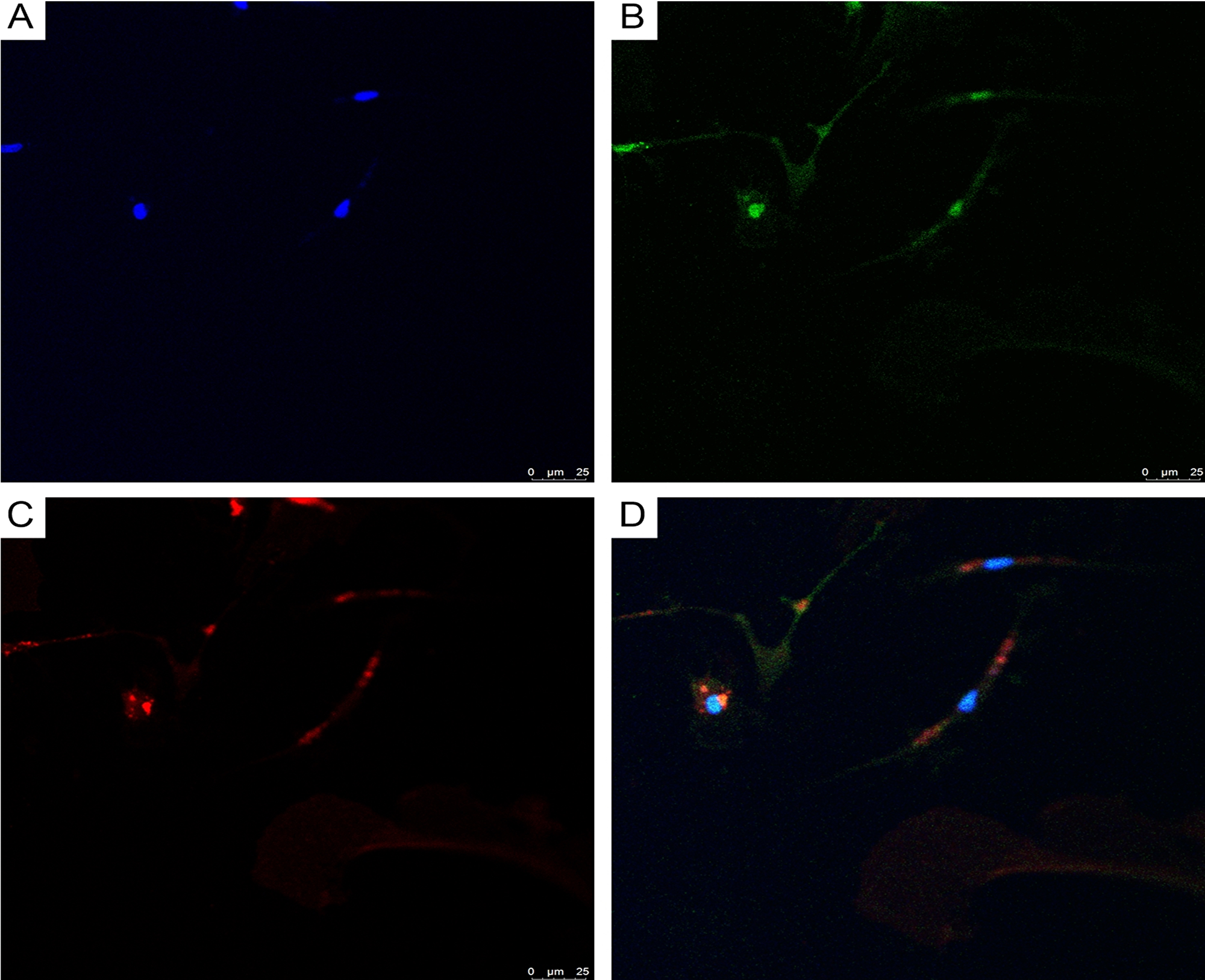 CLSM of glioblastoma primary culture
