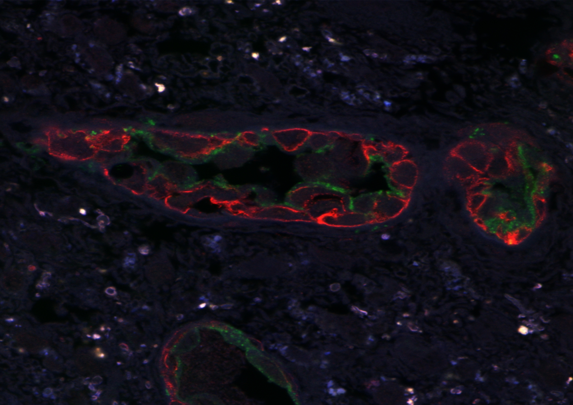 CLSM of glioblastoma