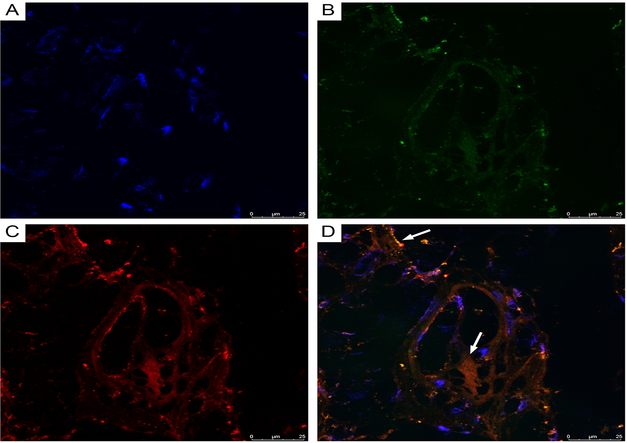 CLSM of glioblastoma
