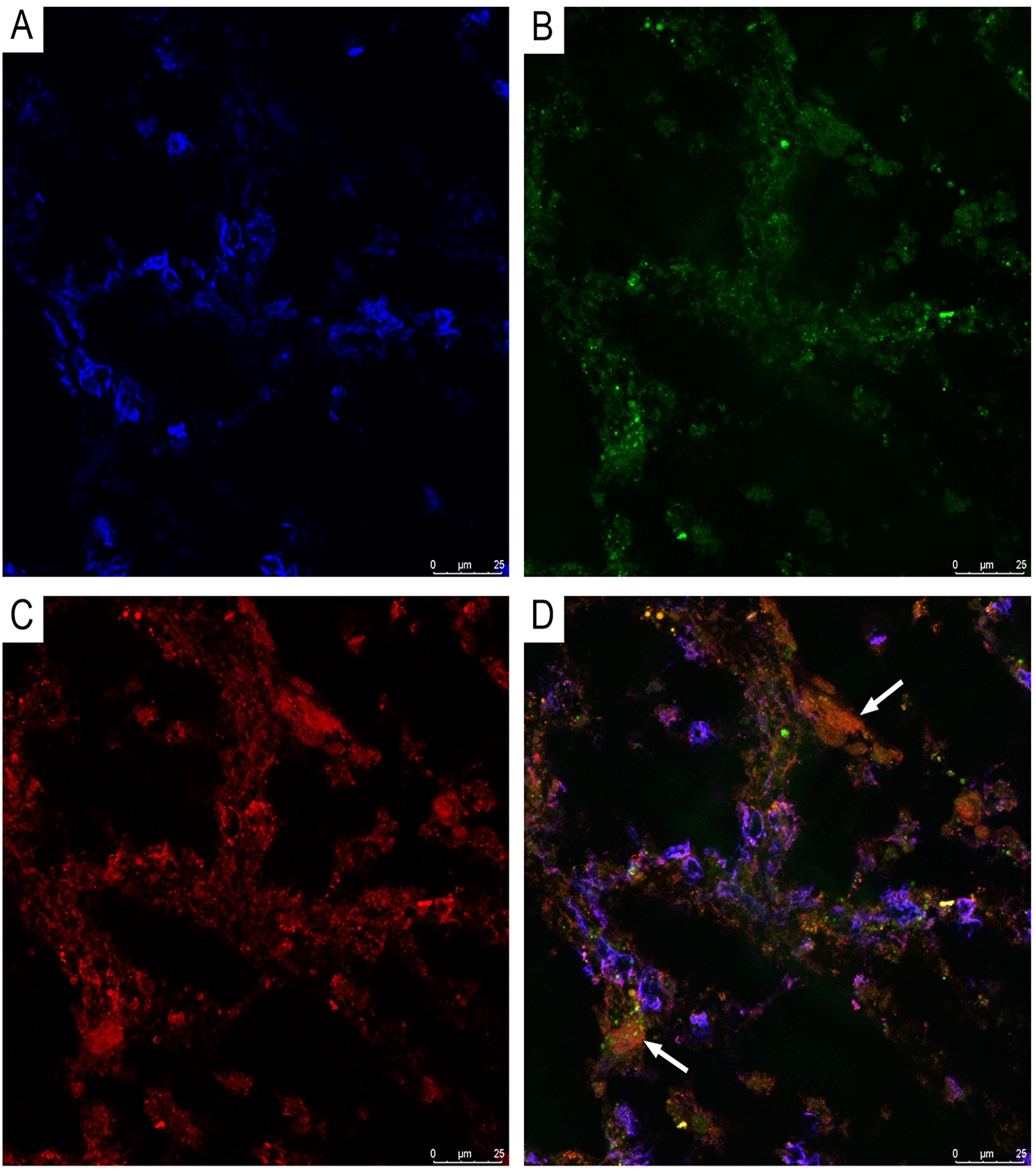 CLSM of glioblastoma