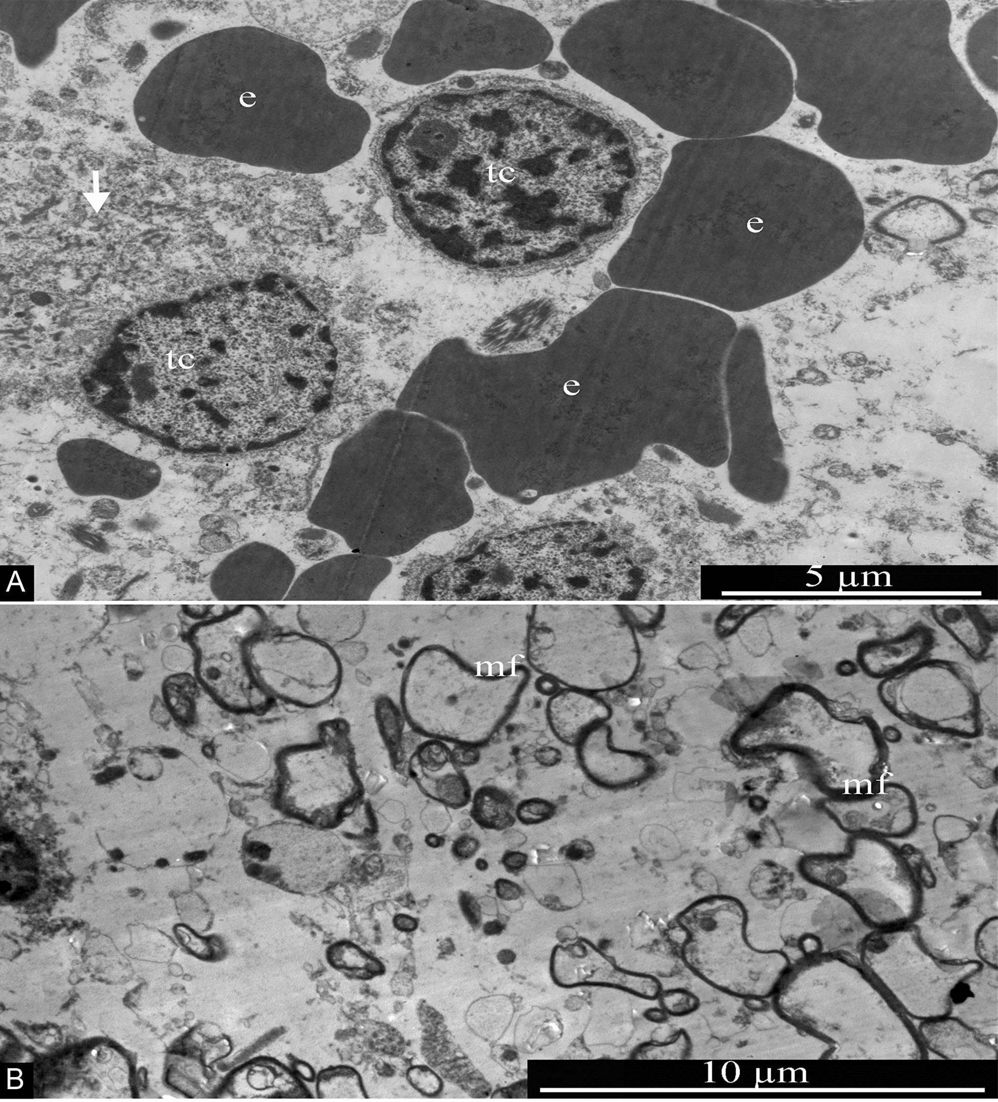 General ultrastructure of glioblastoma