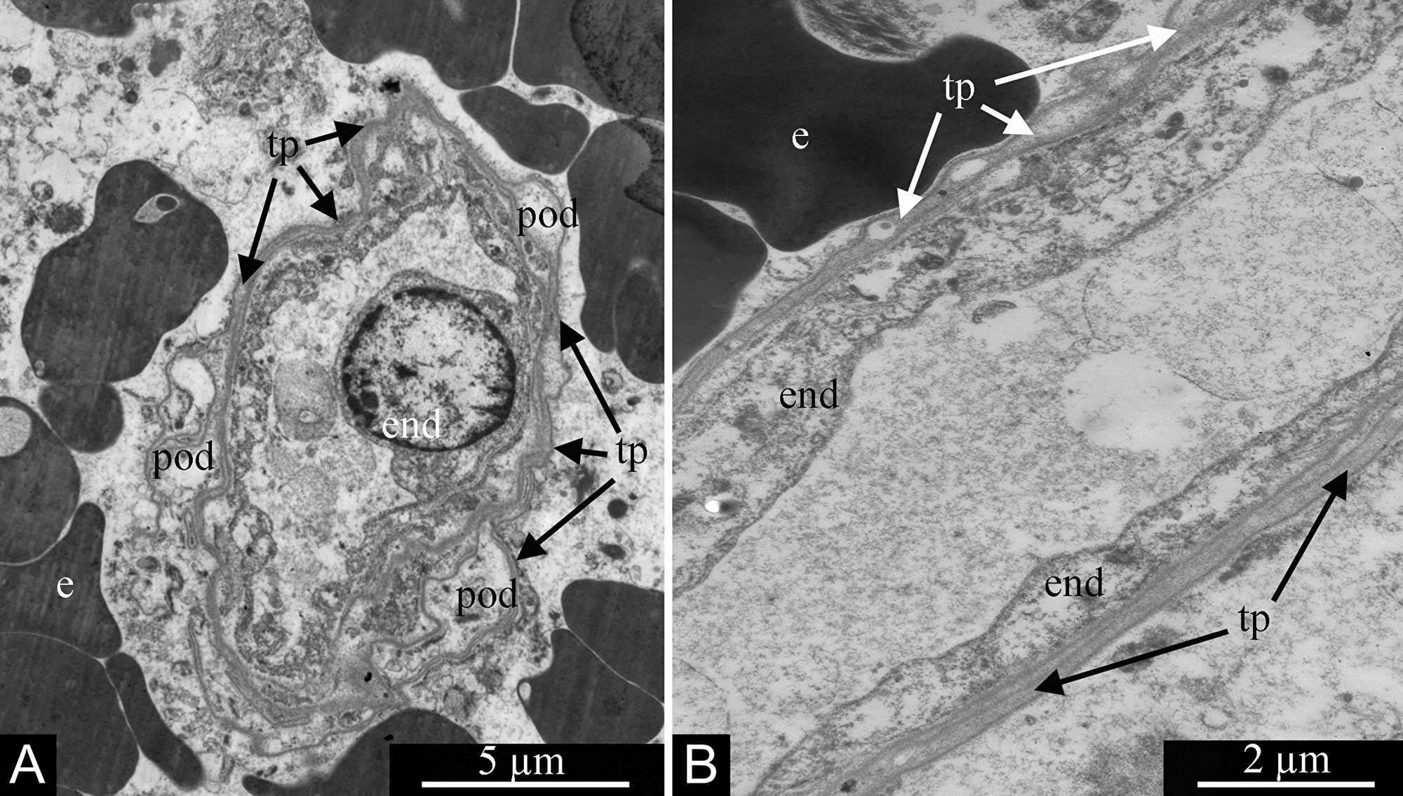 Processes of telocytes (telopodes) in glioblastoma ’s blood capillaries