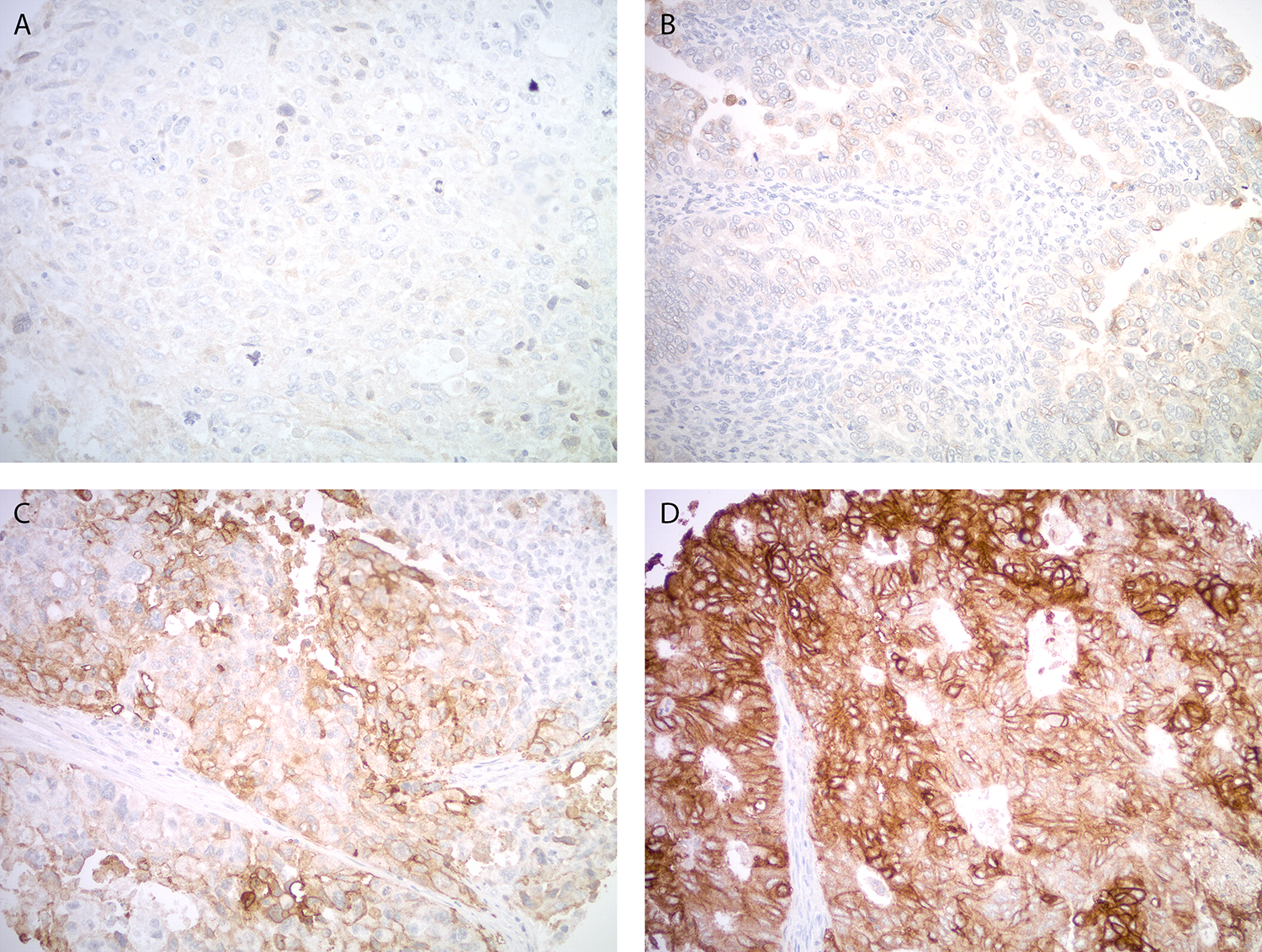 Figure 1: Trop-2 expression by immunohistochemistry in uterine carcinosarcoma.