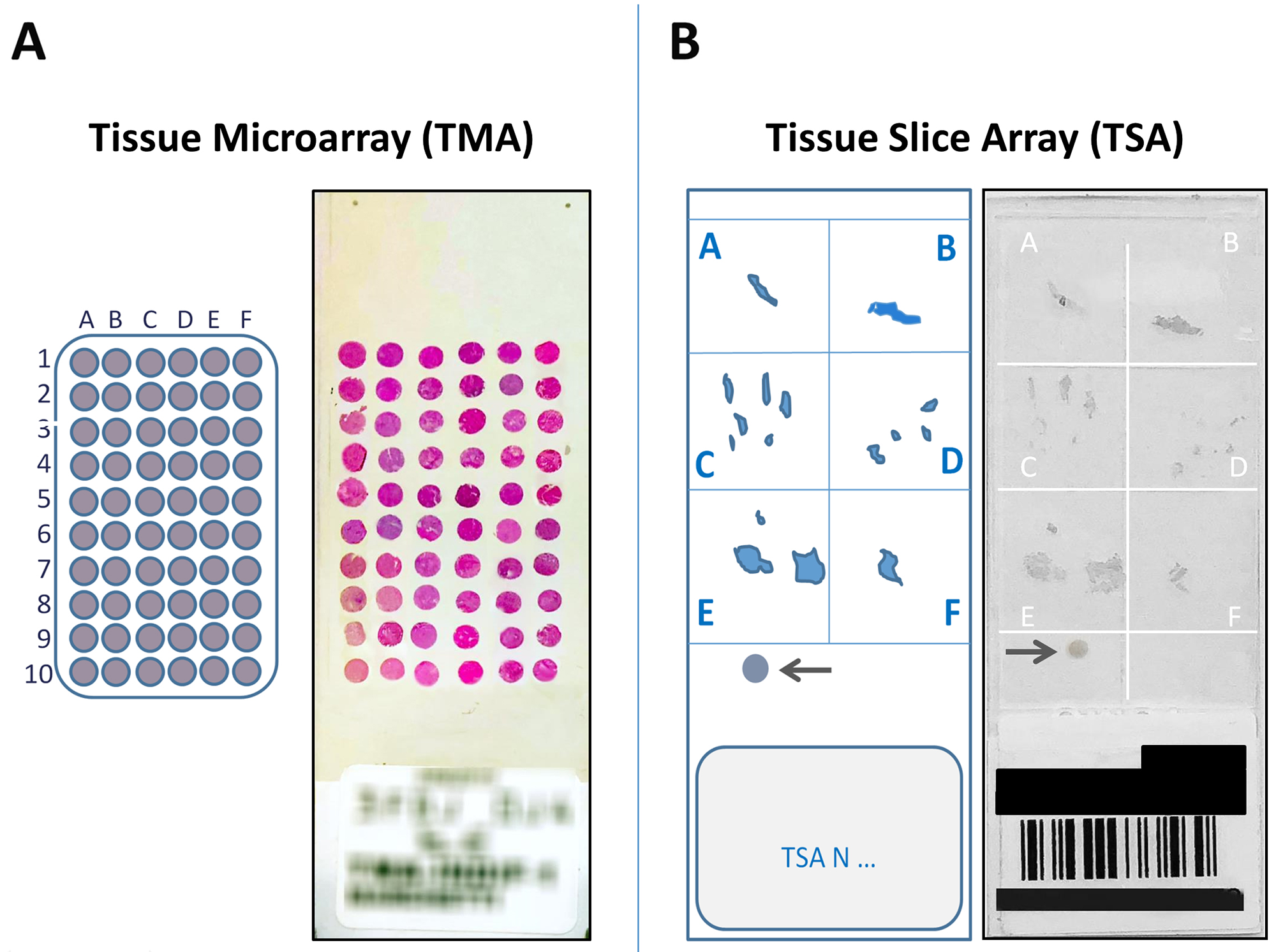 (A) The figure shows a 5 μm section from a 60 cores (30 tumors) Tissue MicroArray (TMA), obtained from large samples, stained with Hematoxylin–eosin, corresponding scheme on the left. (B) An example of a Tissue Slice Array (TSA), obtained from small samples, immunostained with the VENTANA pan-TRK (EPR17341) assay, corresponding scheme on the left. The arrows indicate an internal positive control.