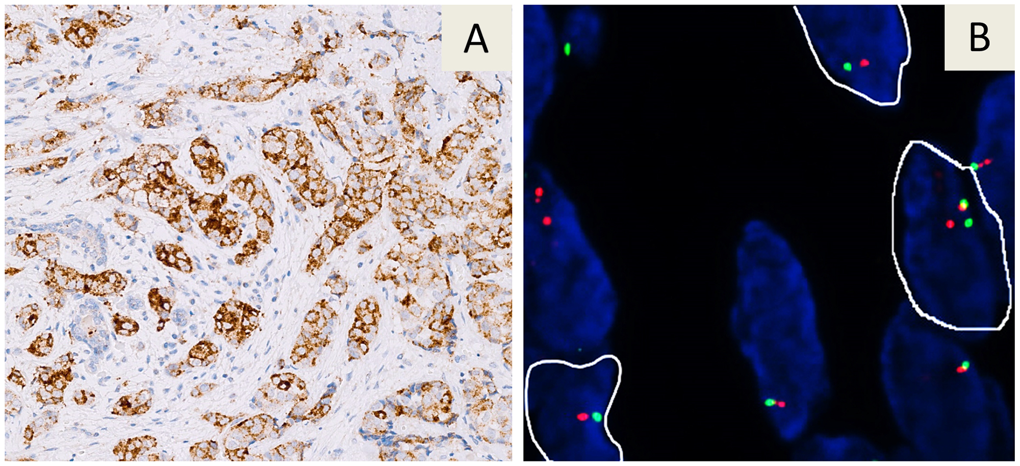 Immunohistochemical staining with the VENTANA pan-TRK (EPR17341) assay in a breast carcinoma