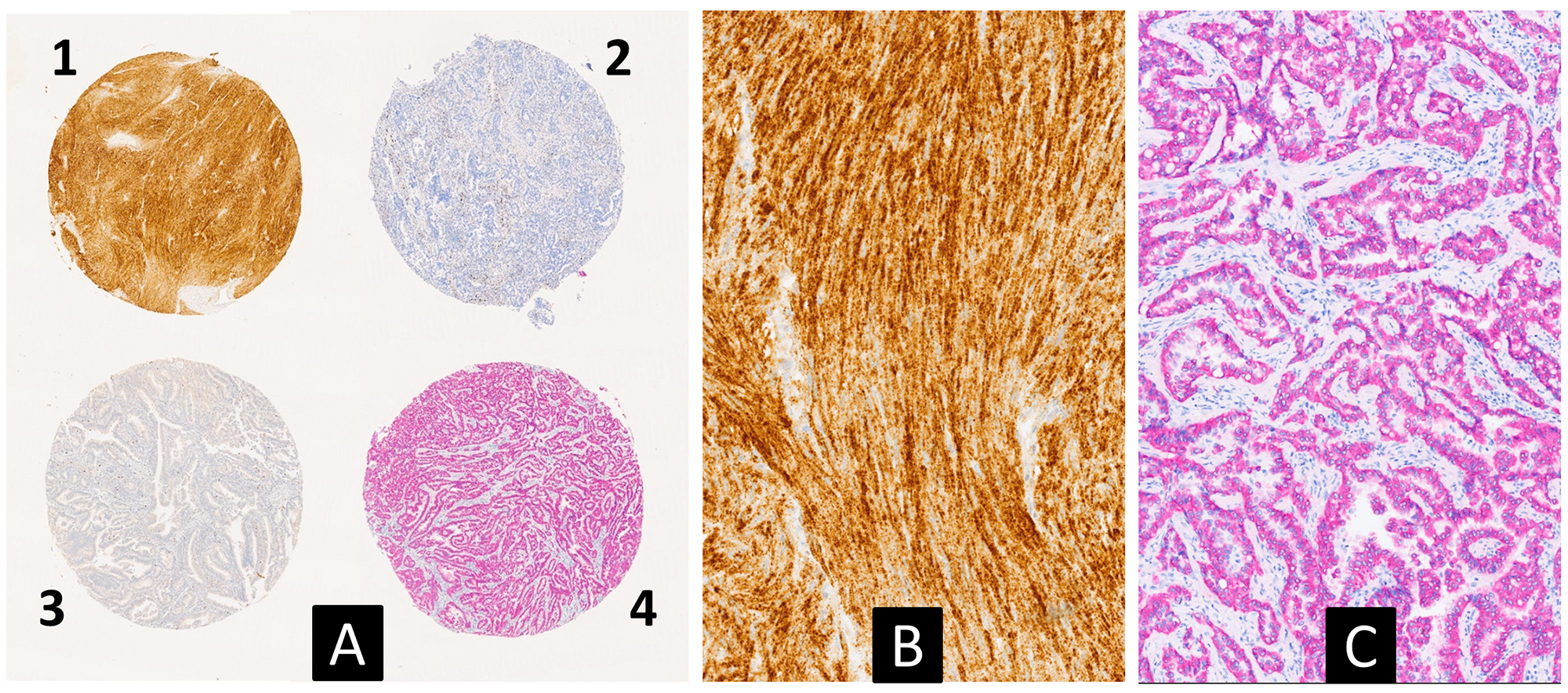 Multiplex immunohistochemical analysis for simultaneous detection of TRK (brown) and ALK1 (red) proteins on a multi-tumor TMA slide (A) (2.5×). Case 1 corresponds to a gastrointestinal stromal tumor, carring a NTRK1 fusion, with a strong TRKA cytoplasmic expression (see also Table 3). Case 4 corresponds to a lung adenocarcinoma with an EML4-ALK fusion showing a cytoplasmic expression of the ALK1 protein. (B and C) are higher magnification pictures of cases 1 and 4, respectively (10×).