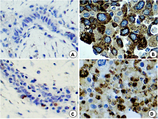 Photomicrography of histological section of a portion of fibroadenoma and breast cancer, showing: (B, D) innumerous cells with strong brown-stained cytoplasm for MMP-2 and MMP-9 in the breast cancer group compared to sparse brown stained cytoplasm in the breast fibroadenoma group (A, C).