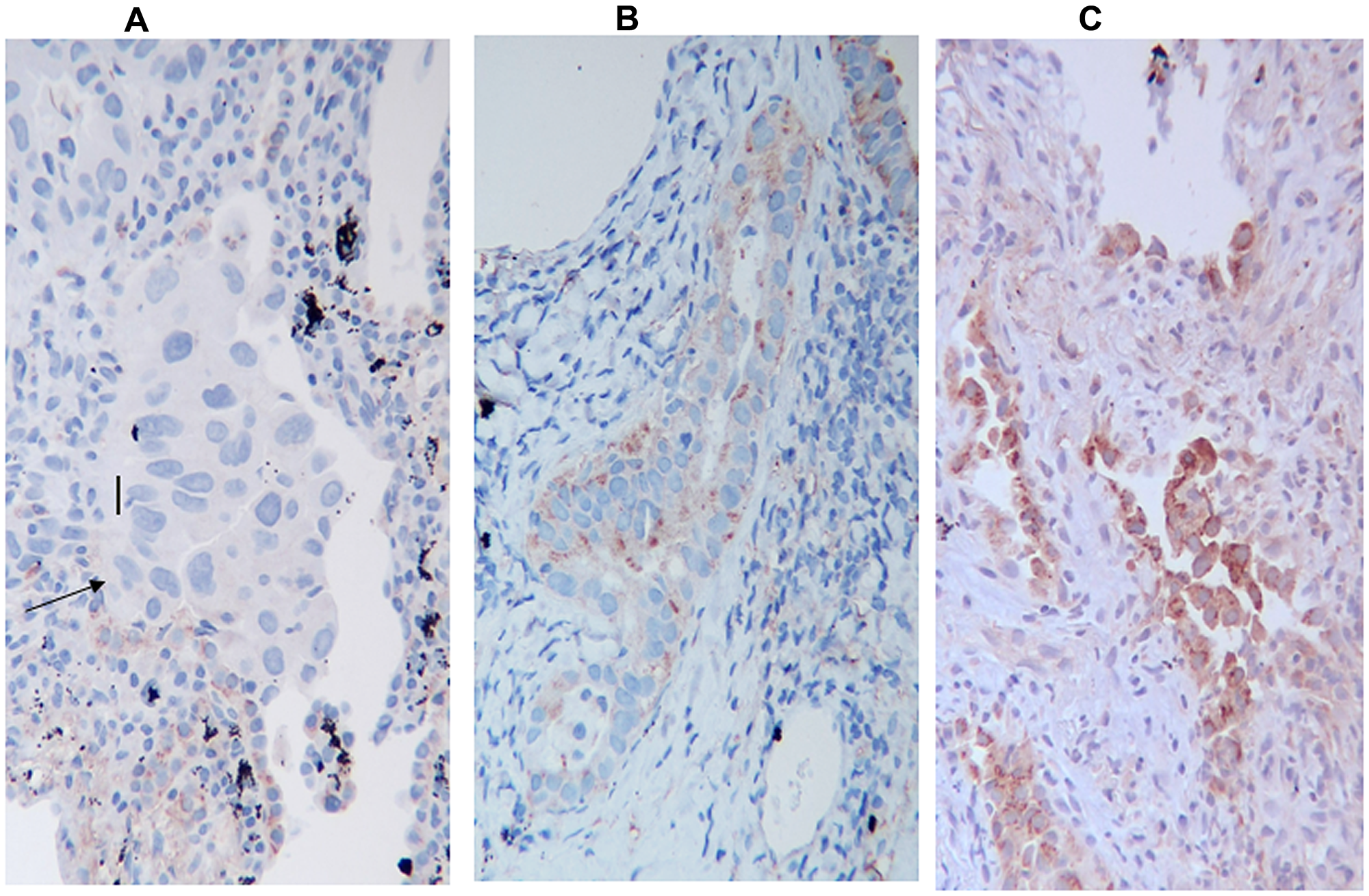 HIF-1α Immunostaining, (A) negative for HIF-1α, (B) mild positive, (C) high positive, The arrow indicates neoplastic cells. The figure indicates only the variation in the intensity of expression and not the percentage of positive cells.