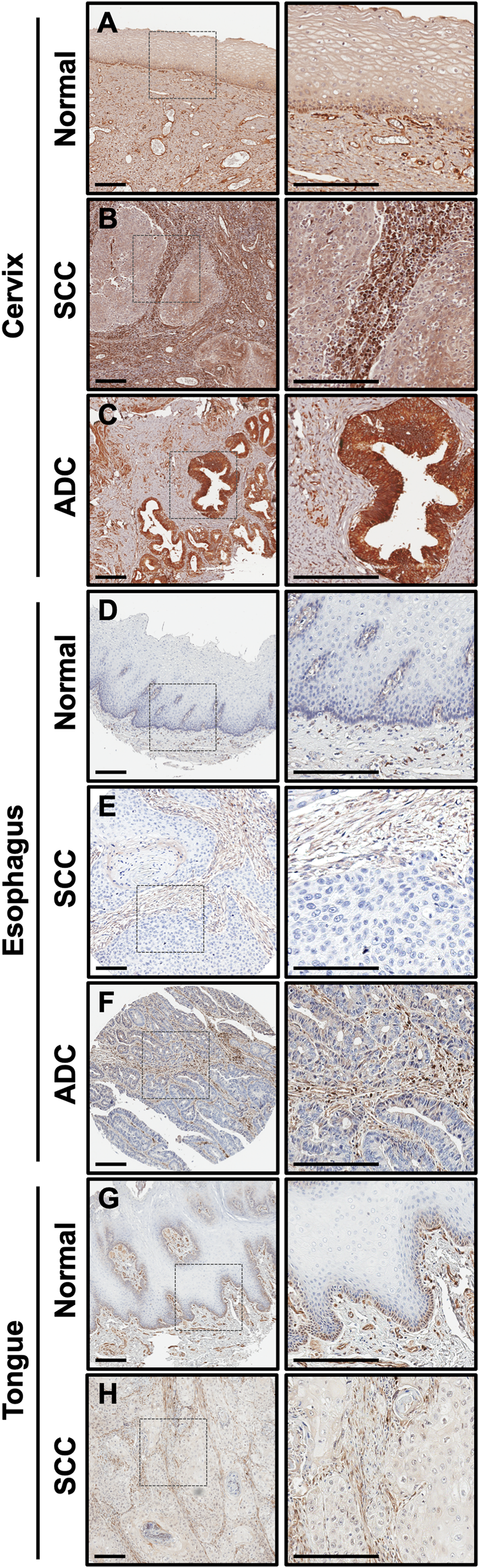 CLIC4 expression is low in epithelia of multiple squamous cancers but elevated in stromal cells