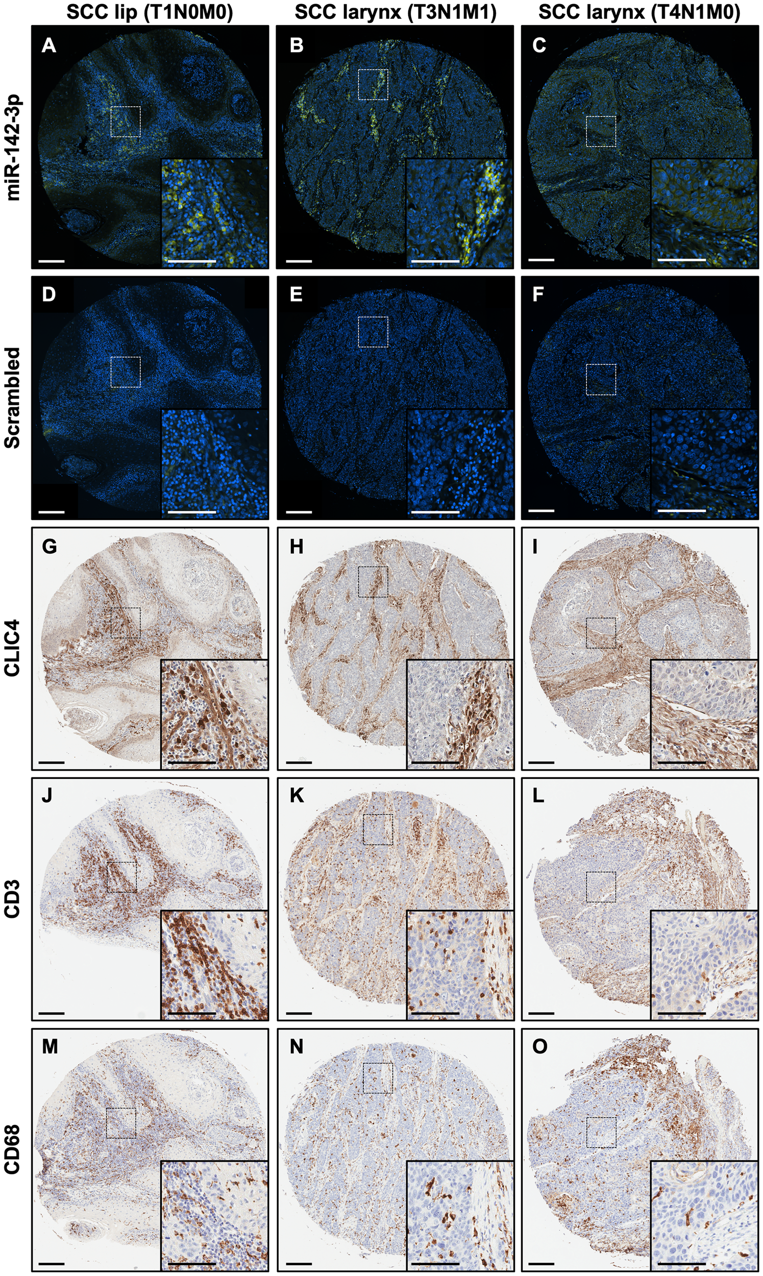 miR-142-3p is expressed in the stromal compartment along with immune cells in HNSCC