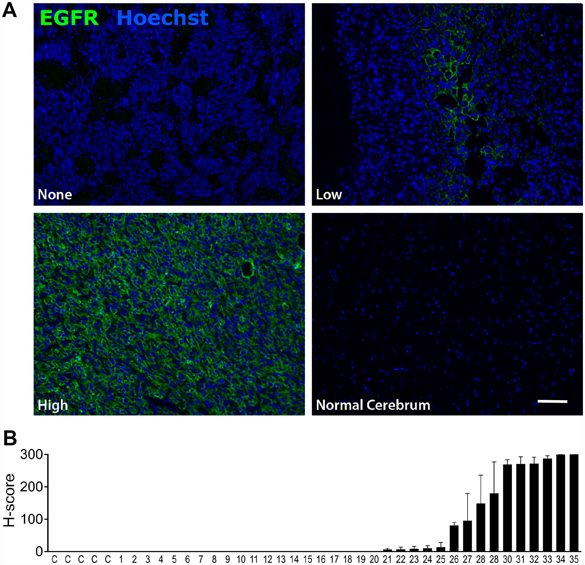 EGFR is expressed in glioblastoma but not in normal brain