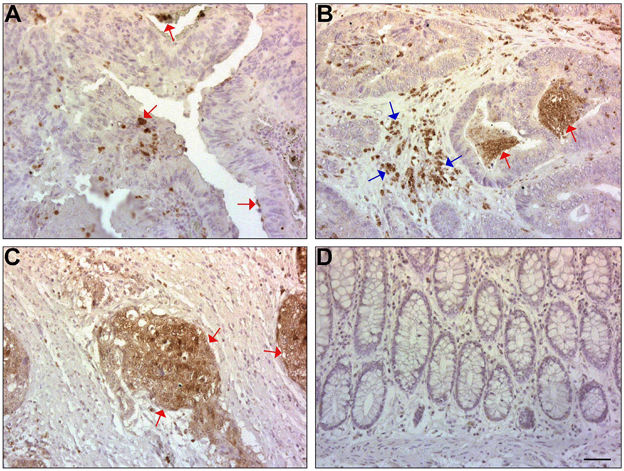 ISG15 expression is induced in CRC tissue and in the adjacent stroma, but not in normal mucosa of the colon