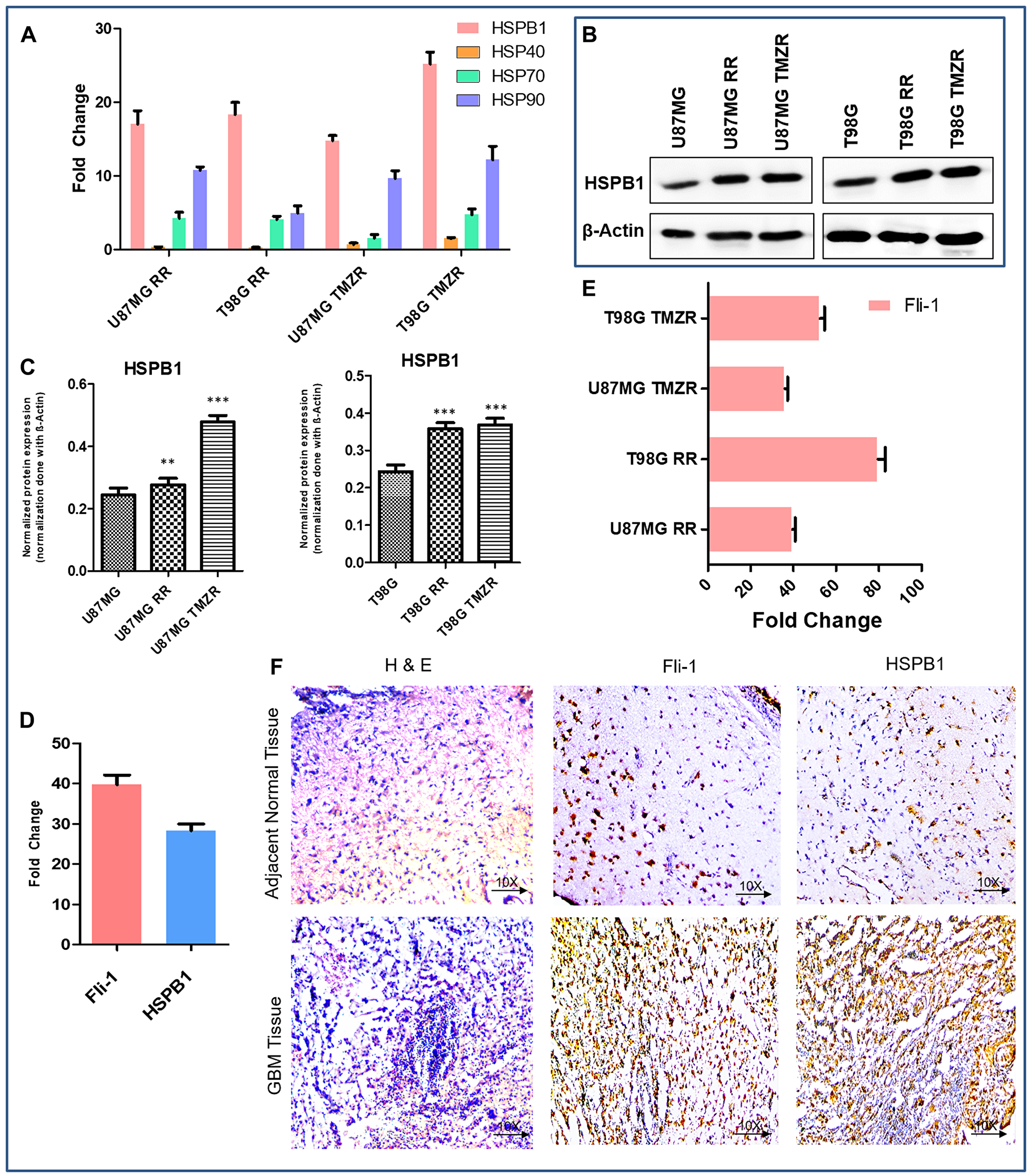 Comparative expression pattern of different HSPs and Fli-1 in GBM
