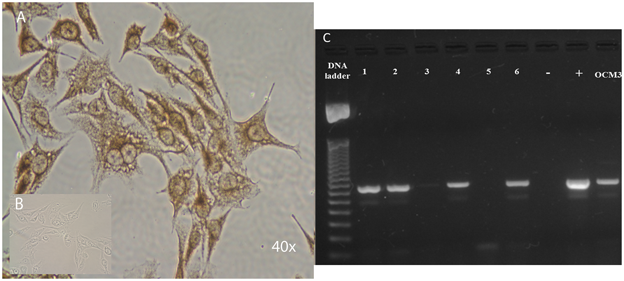 (A) Strong positivity of the full length LHRH receptor as detected by specific antibody in the nucleus, in the cytoplasm and in the membrane by DAB-immunoperoxidase staining. (B) Insert is a negative control for the staining-specificity. Original magnifications of images in immuncitochemistry: 40 ×. (C) Expression of LHRH receptor type I in OCM3 human uveal melanoma cells. The expected PCR products amplified with gene specific primers with 319 bp were detected successfully in OCM3 cell line. DNA ladder: 50 bp ladder (Fermentas), +: positive control (human pituitary); –: no template control, No. 1–6: representative human uveal melanoma tissues.
