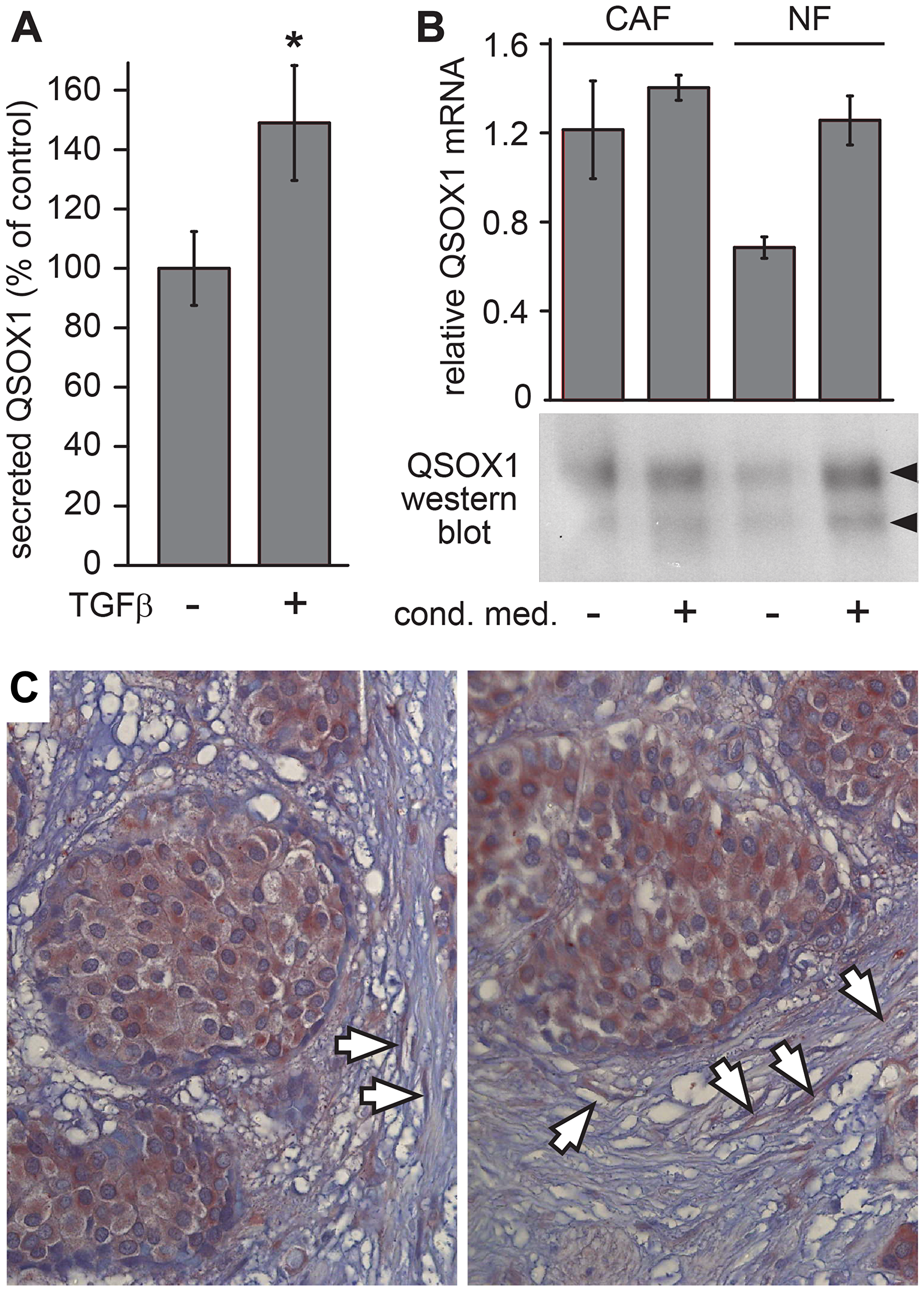 QSOX1 production by tumor-associated fibroblasts