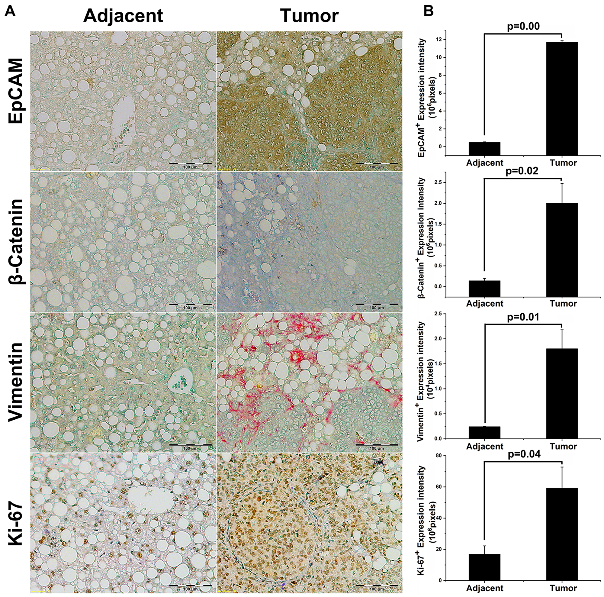 Tumor initiation in EpCAM+ NASH animals exhibits aggressive HCC tumorigenesis