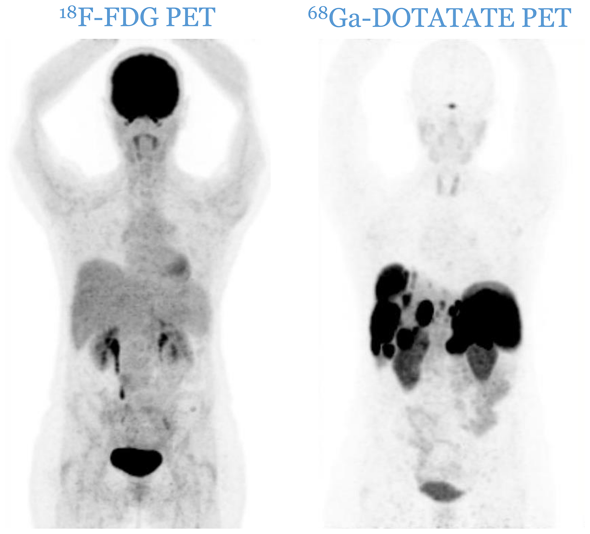 C1 category: all lesions are 18F-FDG negative and 68Ga-DOTATATE positive.