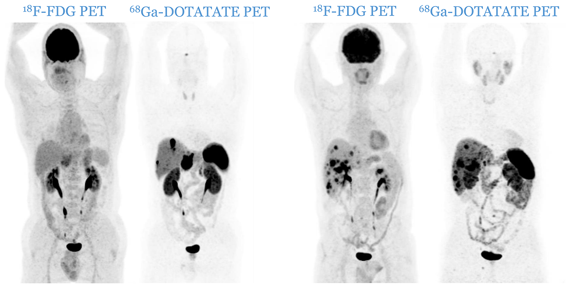 Two cases of patients from C2 category (two pairs of PETs): patients with one or more 18F-FDG positive lesions, all of them 68Ga-DOTATATE positive. There is no mismatch in favor of 18F-FDG.