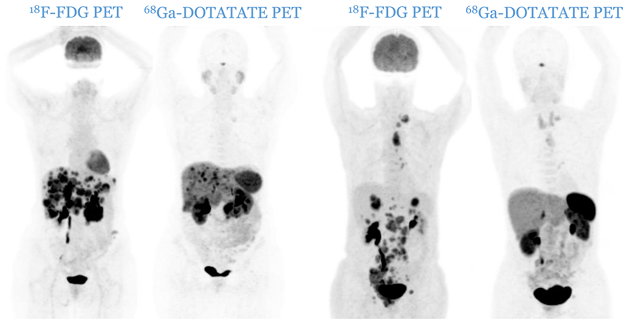 Two cases of patients from C3 category (two pairs of PETs): patients with one or more 18F-FDG positive lesions, all of them 68Ga-DOTATATE negative. A mismatch in favor of 18F-FDG is observable.