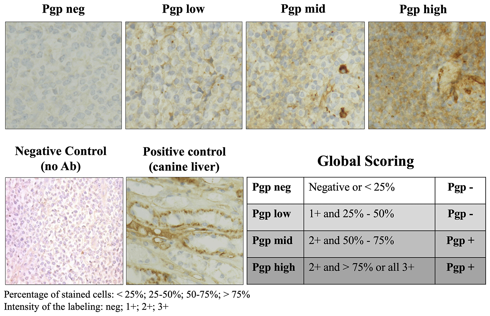 P-glycoprotein expression evaluated by immunohistochemistry in lymph node tumor cells