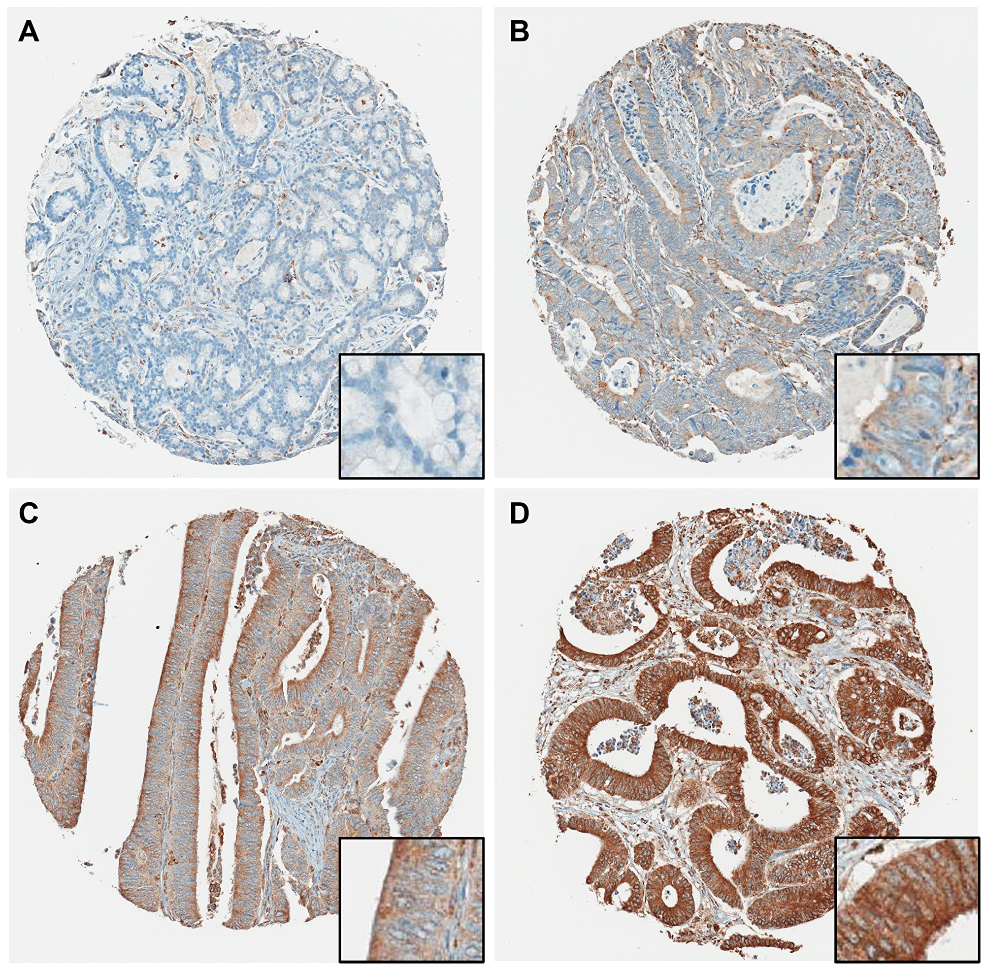 Representative P4HA1 immunohistochemical staining showing four different TMA cores