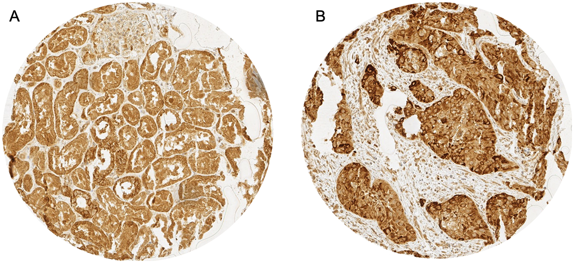 Representative images of p16 immunostaining in (A) p16 cytoplasmatic (red arrow) and nuclear (blue arrow) staining in adenocarcinoma and (B) p16 cytoplasmatic staining in squamous cell carcinoma.