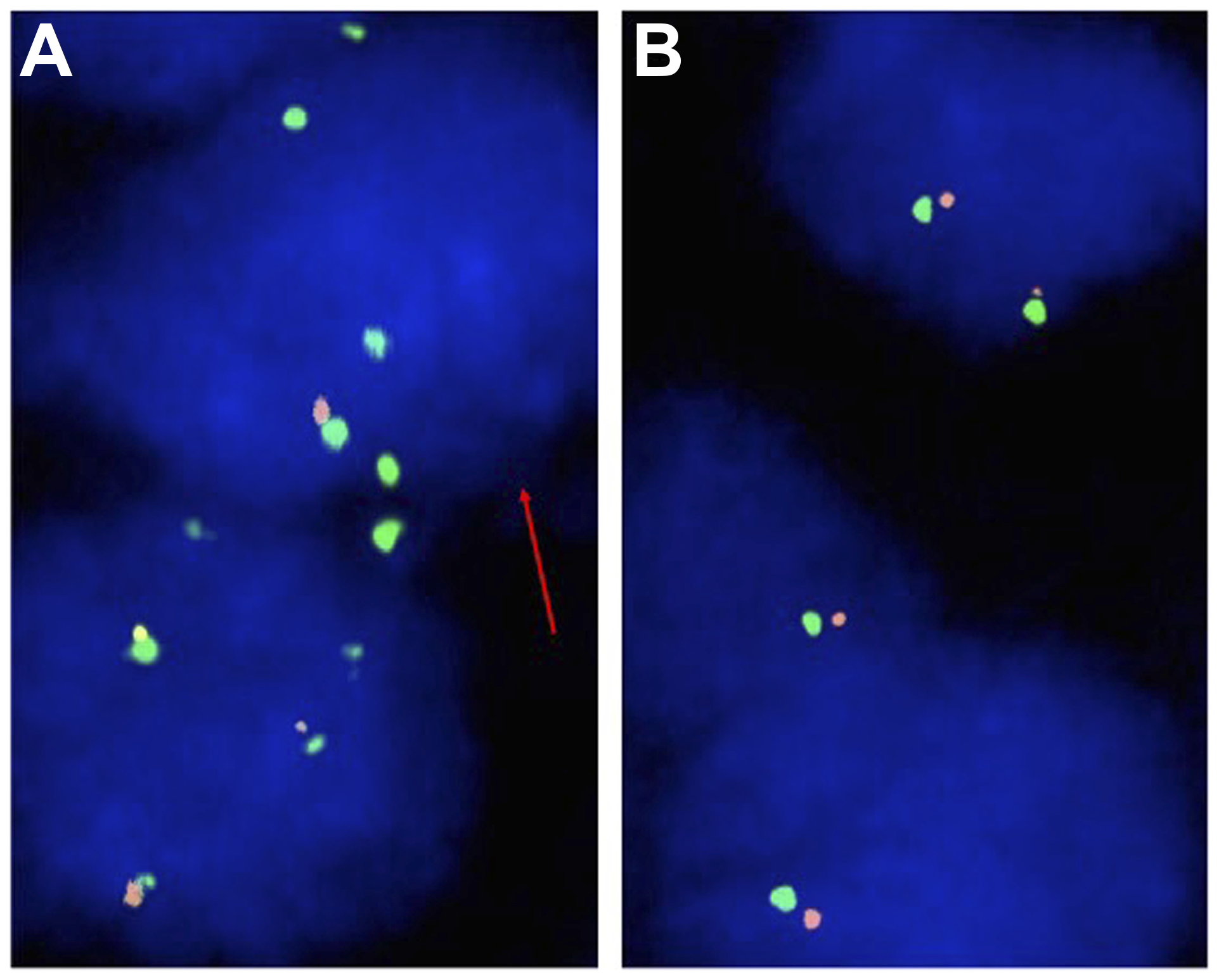 Representative FISH images of CDKN2A (A) Heterozygous CDKN2A deletion indicated by the lack of one orange CDKN2A signal and two green centromere 9 signals in the tumor cell nucleus (red arrow) and (B) Normal CDKN2A copy number indicated by two orange CDKN2A signals and two green centromere 9 signals.