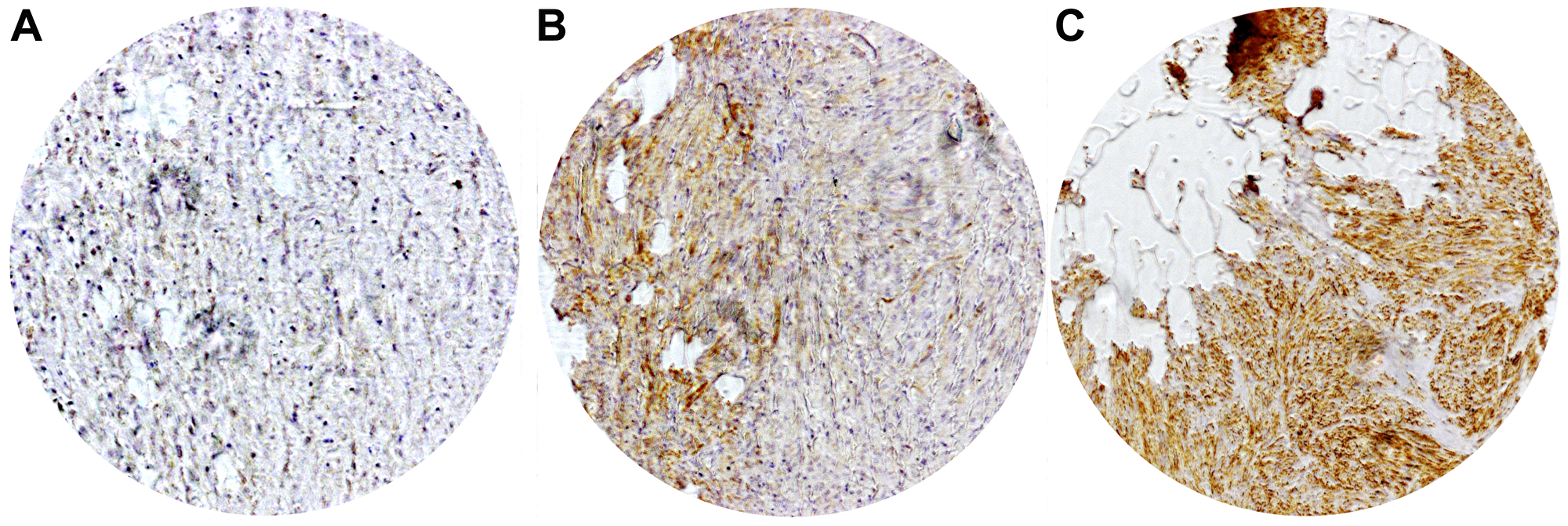 Representative immunohistochemical staining of local CHL1 expressions in GIST